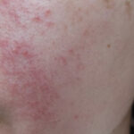 지루성피부염 원인