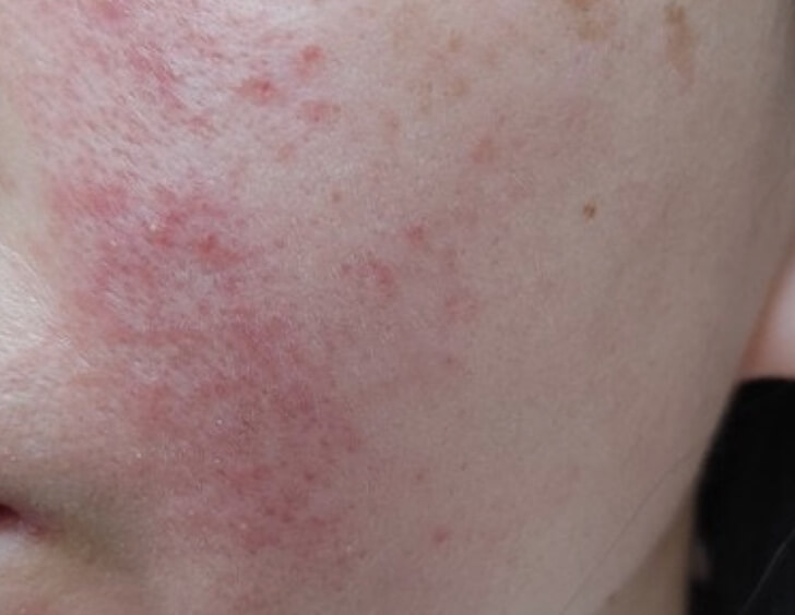 지루성피부염 원인