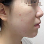 판톤텐산 복용 후기