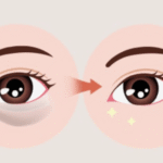 눈밑지방재배치 붓기