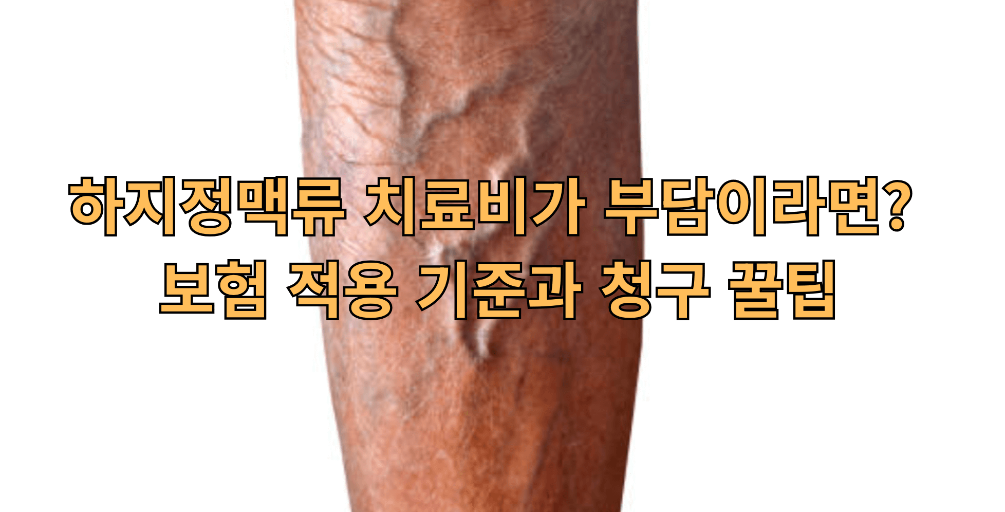 하지정맥류 보험적용