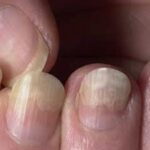 조갑박리증 손톱무좀 원인