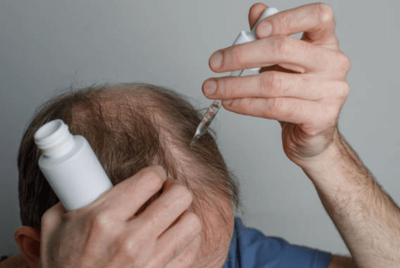 탈모 치료 미녹시딜 바르기