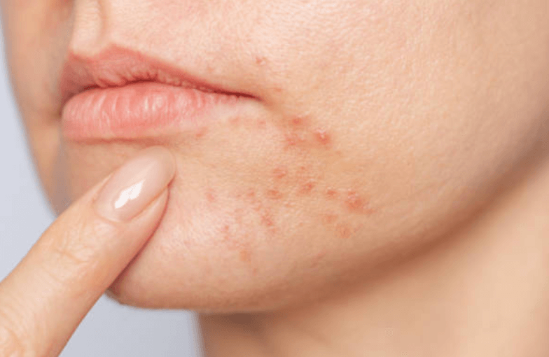 여드름 같은 자리에 반복