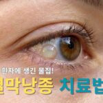 결막낭종 원인과 결막낭종 치료를 명확히 보여주는 눈 흰자 물혹, 물집 이미지로, 독자의 궁금증을 해소하고 결막낭종 관리법과 치료법에 대한 이해를 돕습니다.