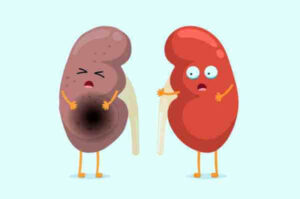 신장 이상 증상 5가지와 신장 건강 관리법을 확인하여 신장 기능 저하 및 만성 콩팥병을 예방하고 체내 노폐물을 원활하게 배출하는 해결책을 만나보세요.