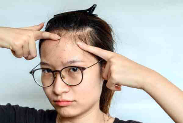 이마 좁쌀여드름 연고 선택 전 피부과 전문 압출과 스케일링으로 모공 속 노폐물을 배출하여 피부 요철을 개선하는 간단한 방법