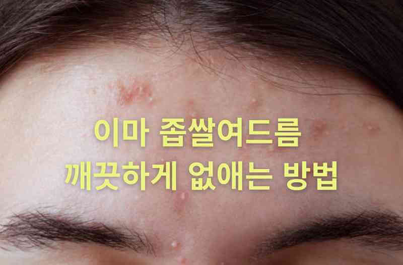 이마 좁쌀여드름 원인 해결을 위해 묵은 각질과 피지를 제거하여 매끄러운 피부를 만드는 3가지 전문 치료법과 흉터 예방 관리 가이드