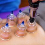 부항 효과와 부작용, '이 증상' 있다면 절대 하지 마세요