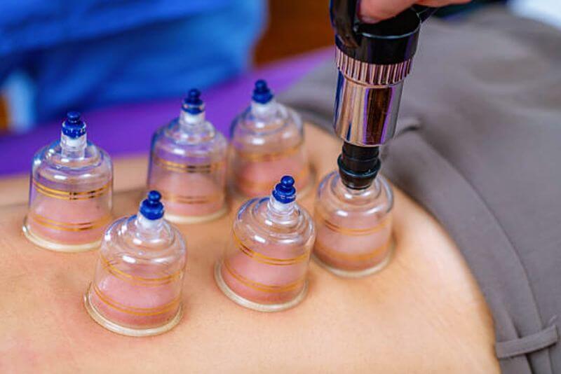 부항 효과와 부작용, '이 증상' 있다면 절대 하지 마세요