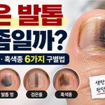 검은 발톱 무좀 6가지 구별법