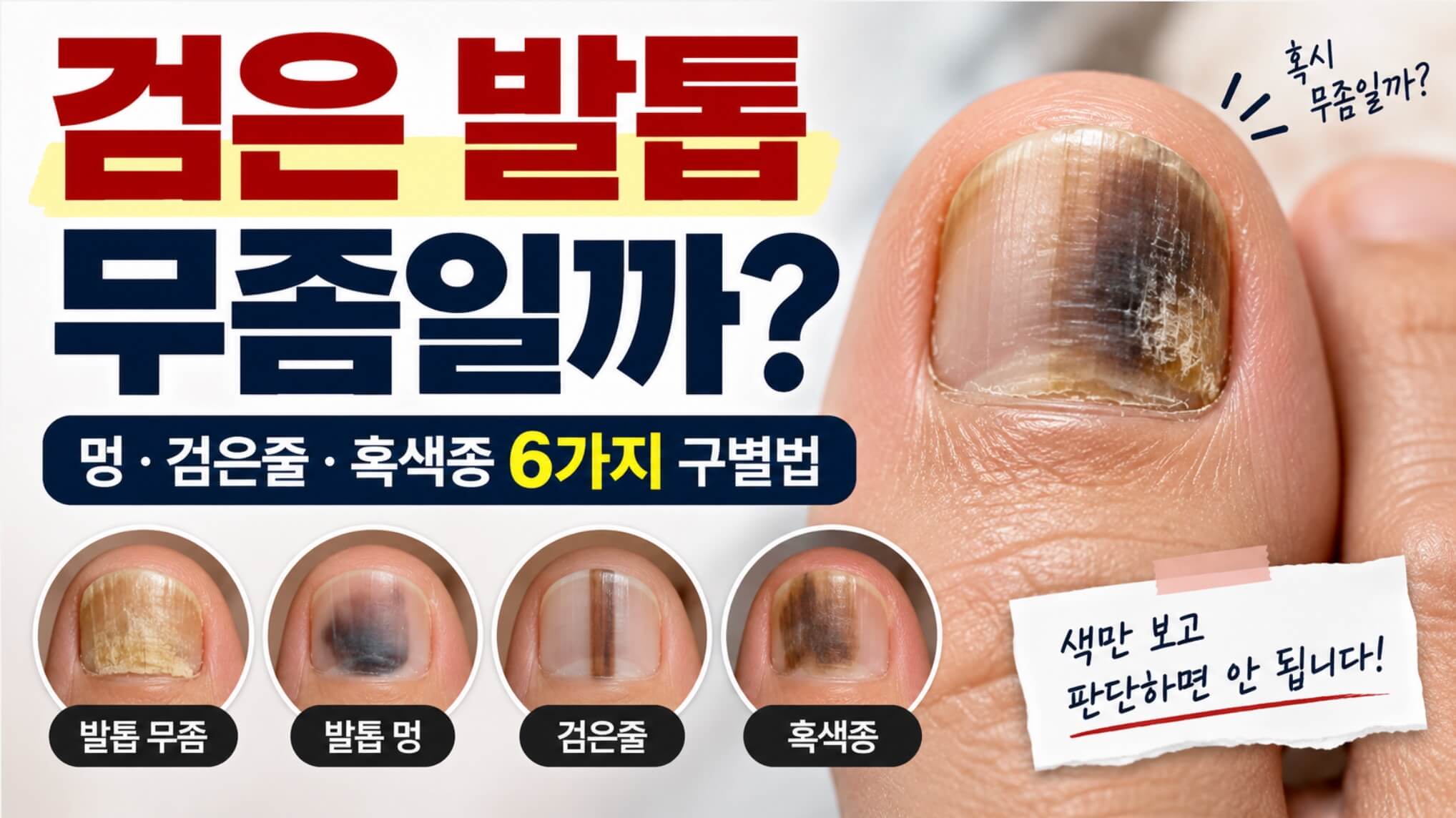 검은 발톱 무좀 6가지 구별법