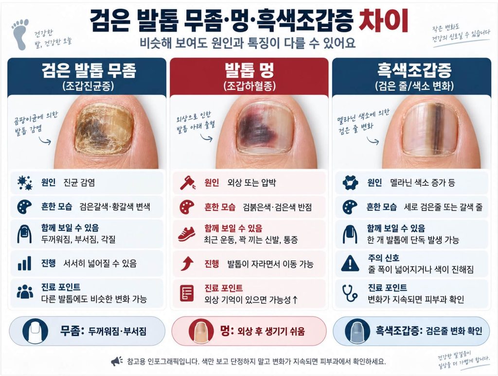 검은 발톱 무좀 멍 흑색조갑증 구별