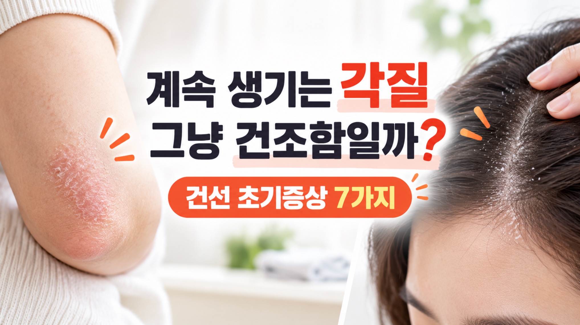 건선 초기증상, 팔꿈치나 두피에 각질이 계속 생긴다면 건선일 수도? 7가지 확인법