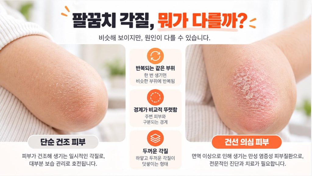 건선 초기증상 팔꿈치 각질과 일반 건조 피부 차이