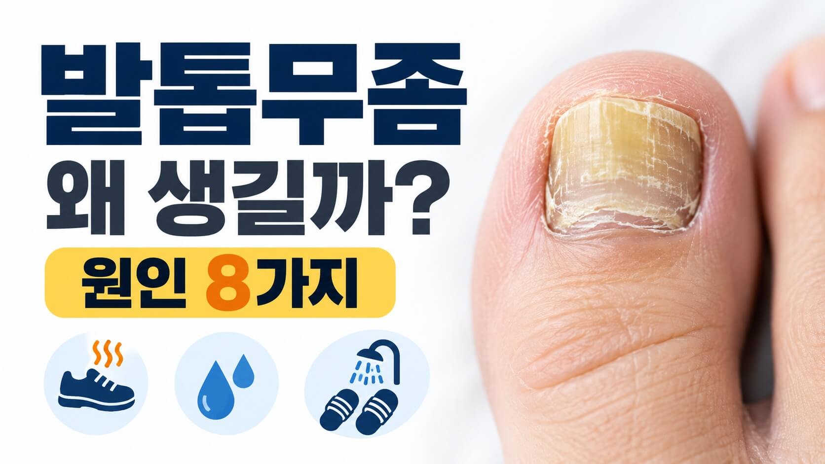 발톱무좀 원인 8가지 곰팡이균 감염