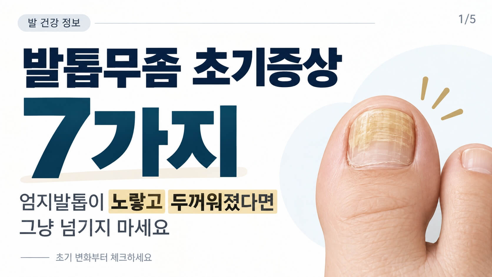 발톱무좀 초기증상 7가지, 엄지발톱이 노랗고 두꺼워졌다면 확인하세요