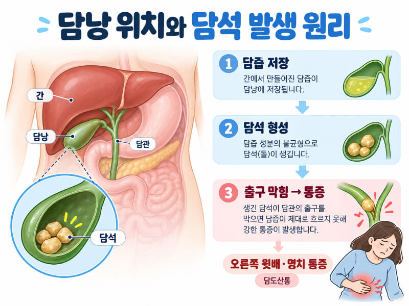 오른쪽 윗배가 쥐어짜듯 아프다면 담석증, 이런 증상까지 나타나면 위험하다